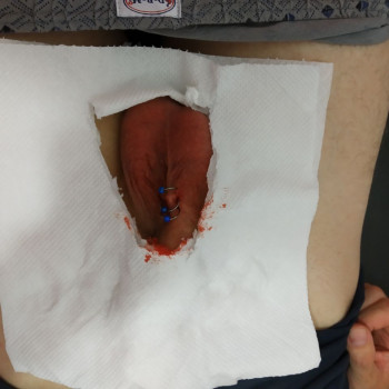 Интим пирсинг
                    Мастер по пирсингу Валентина Одесса