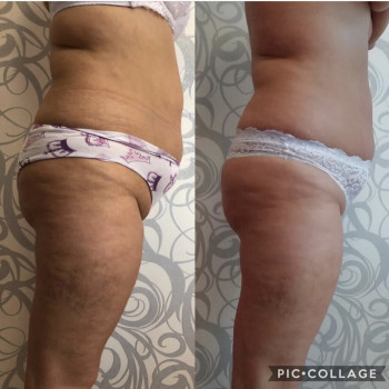 Вакуумный лимфодренажный массаж
                    Массажист Юлия Полтава