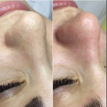 Механическая чистка лица
                    Косметолог Оксана Оринник Харьков