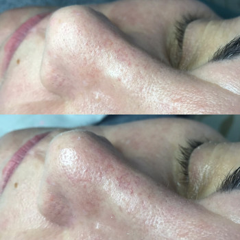 Механическая чистка лица
                    Косметолог Оксана Оринник Харьков