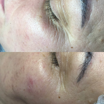 Механическая чистка лица
                    Косметолог Оксана Оринник Харьков