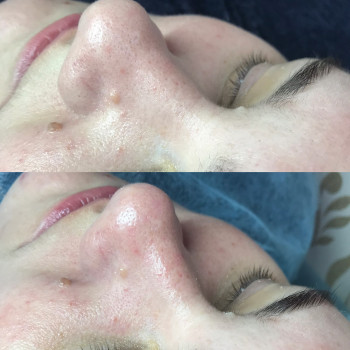 Механическая чистка лица
                    Косметолог Оксана Оринник Харьков