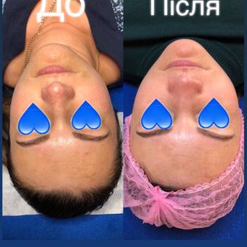 Пілінг Lightening 