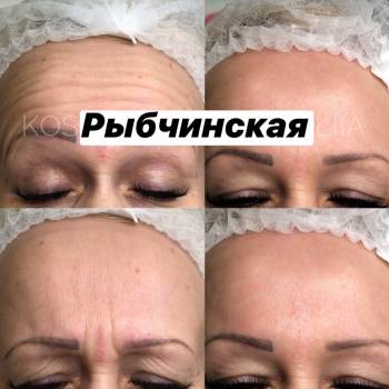 ботокс лба, ботокс межбровье