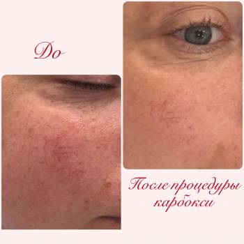 До и после процедуры карбокситерапии