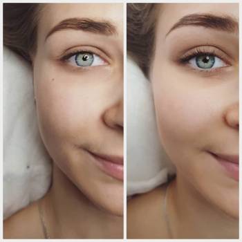 Ламинирование: до и после