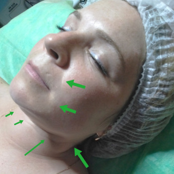 результат 7 сеансов массажа (несколько видов техник)