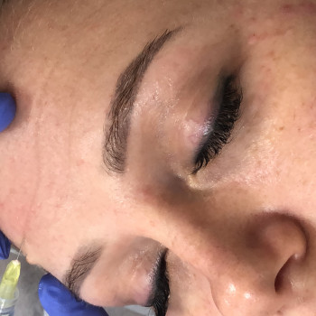 Мезотерапия лица
                    Косметолог Анна Чехова Харків