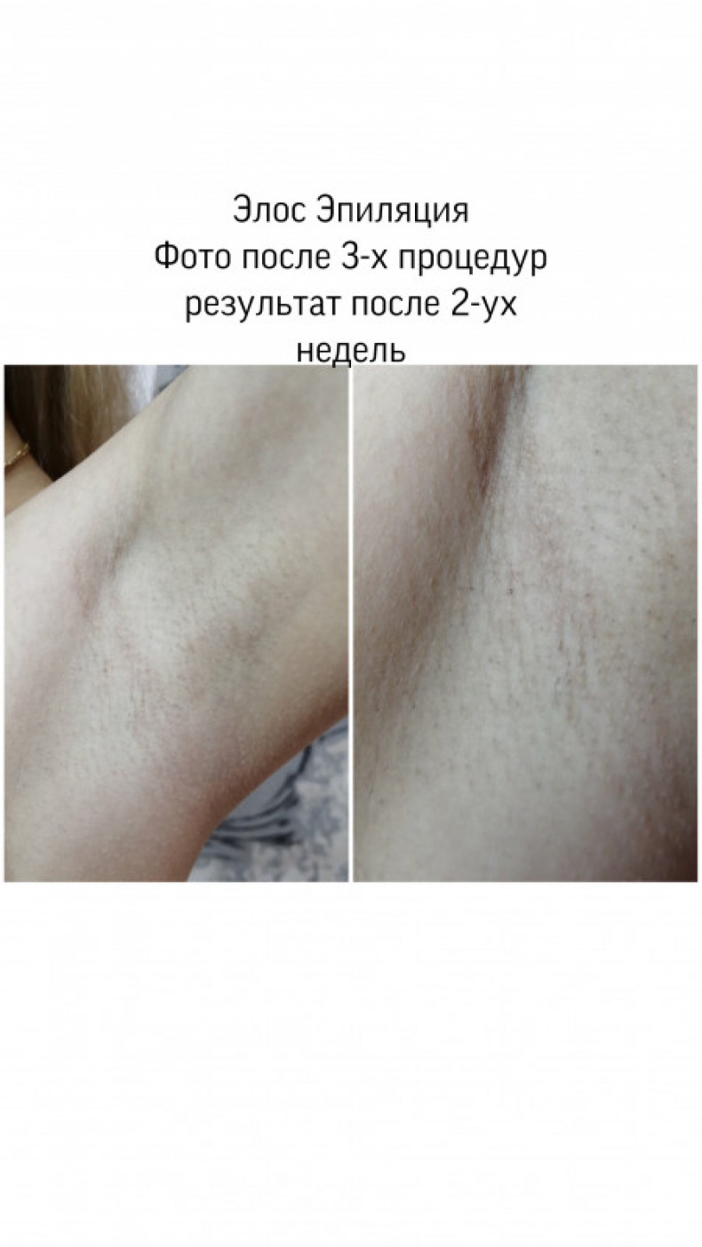 Элос Эпиляция, фото -  