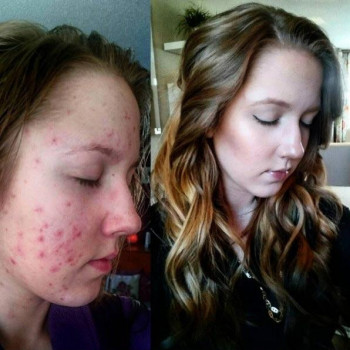 Проблемная кожа 