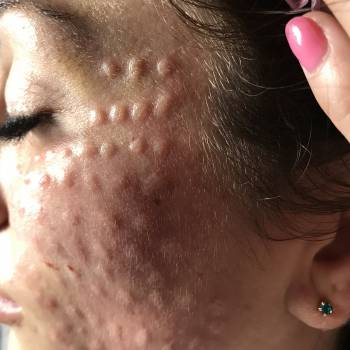 Биоревитализация препаратом Aquashine.
ПОКАЗАНИЯ К ПРИМЕНЕН