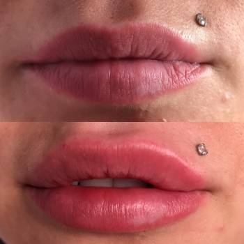 Аугментация губ, выполнена препаратом Neuramis Deep, 1 мл.