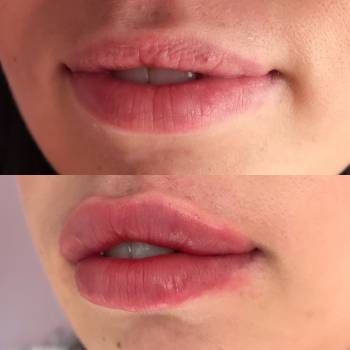 Аугментация губ, выполнена препаратом Neuramis Deep, 1мл.