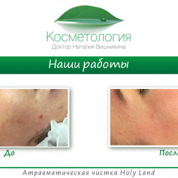 Атравматична чистка обличчя Holy Land (Ізраїль)
                    Косметологічний центр Косметология Наталии Вишникиной Київ