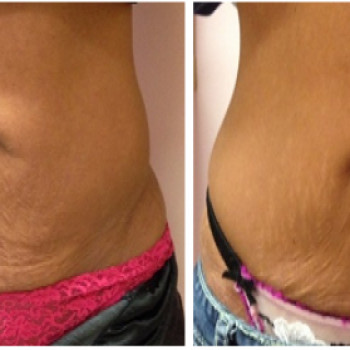 RF лифтинг по телу
                    Масажист Алиса Київ