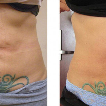 RF лифтинг по телу
                    Масажист Алиса Київ