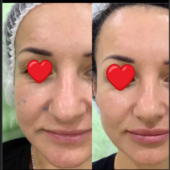 Контурная пластика
                    Дерматолог косметолог Алёна Николаев