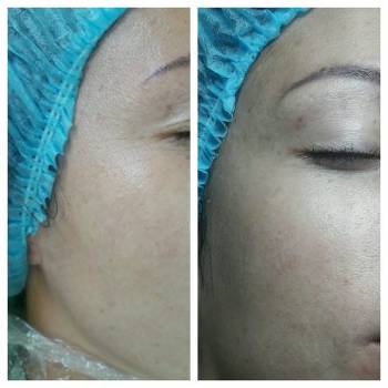 Ревитализация. Разглаживание морщинок под глазами