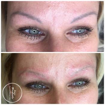 Лазерное удаление старого татуажа 