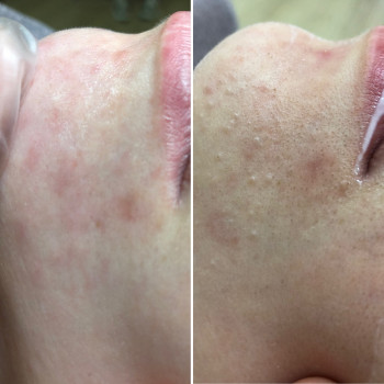 Глубокая чистка лица
                    Косметолог-ін'єкціоніст София Николаевна Київ