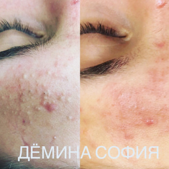 Глубокая чистка лица
                    Косметолог-ін'єкціоніст София Николаевна Київ