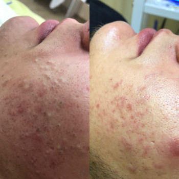 Глубокая чистка лица
                    Косметолог-ін'єкціоніст София Николаевна Київ