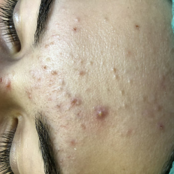 Глубокая чистка лица
                    Косметолог-ін'єкціоніст София Николаевна Київ