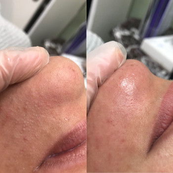 Глубокая чистка лица
                    Косметолог-ін'єкціоніст София Николаевна Київ