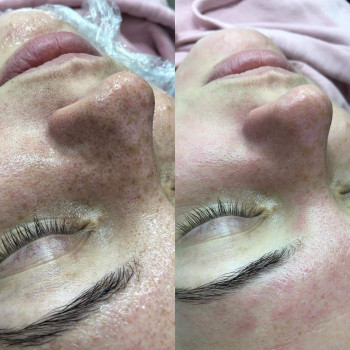 Глубокая чистка лица
                    Косметолог-ін'єкціоніст София Николаевна Київ