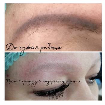 Тату видалення татуажу татуаж губ тату, фото - Салон краси Studio Shishenko