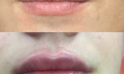 Контурная пластика губ Дерматолог косметолог Алёна Николаев