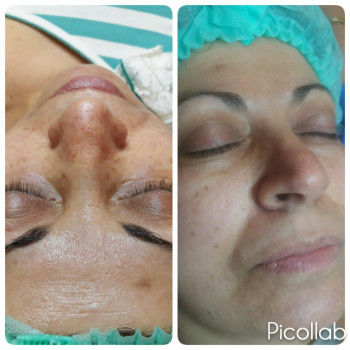  
До и после 3 пилингов.(осветление лица и век)