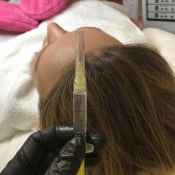 Мезотерапия волос 