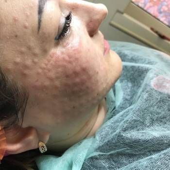 Биоревитализация 