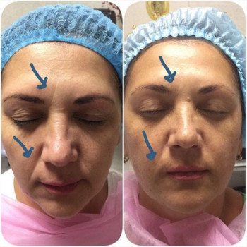 Альгинатная маска для лица
                    Салон красоты Марти Харьков