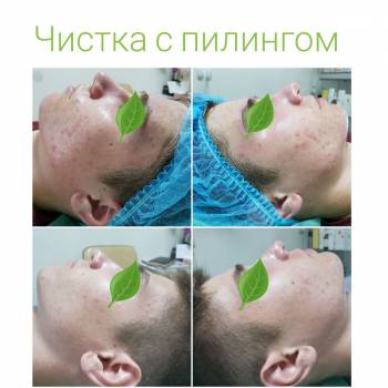 Чистка с пилингом