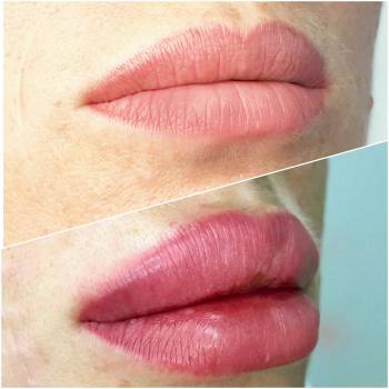 Увеличение губ