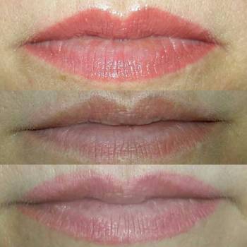 1. Старый татуаж губ
2. После удаления(5 процедур)
3. После 