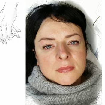 ПМ 3х зон (брови, веки, губы) зажившие