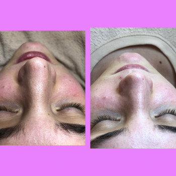 Фото з портфоліо косметолога Алина Ловакова (Дніпро)