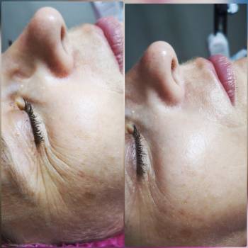 Пилинг для нежной кожи век