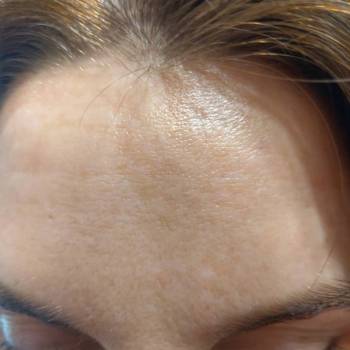 Восстановление рельефа кожи и устранение морщин с помощью Ди