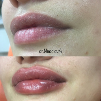 Контурная пластика губ
                    Дерматолог косметолог Алёна Николаев