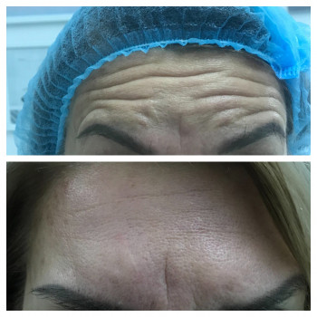 Инъекции Ботулотоксина
                    Косметолог-эстетист Виктория Черкассы