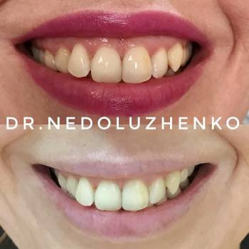 Корекція гінгівальної посмішки методом ботулінотерапіі.