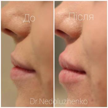 Контурна пластика губ.