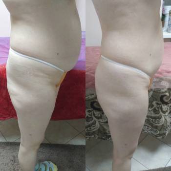 После 6 сеансов антицеллюлитного массажа