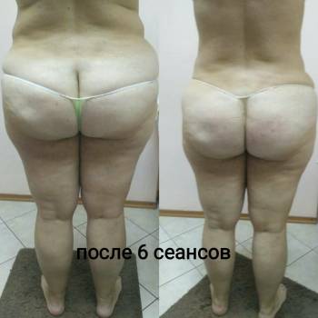 После 6 сеансов антицеллюлитного массаж+3 обёртывания