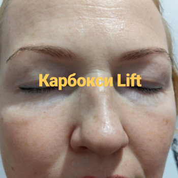 Карбокситерапия
                    Косметолог Ирина Орел Харьков