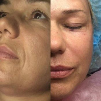 Карбокситерапия
                    Косметолог Ирина Орел Харьков